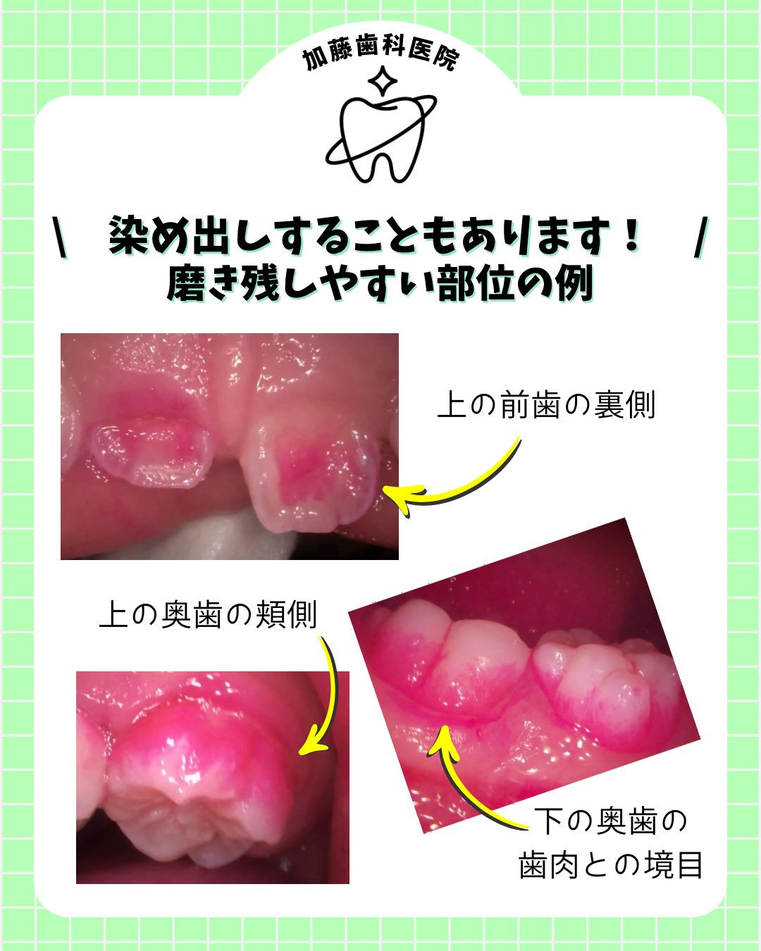 こんにちは♪加藤歯科医院です🦷🪥